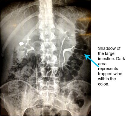 xtrapped-intestinal-gas-on-x-ray-of-the-abdomen.jpg.pagespeed.ic.VkkUe5OZI3.jpg