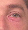 stye.gif